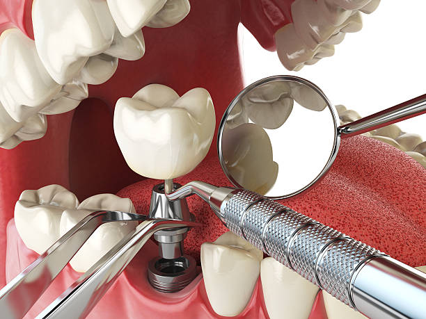 Best Emergency Wisdom Teeth Removal in Edgewood, MD